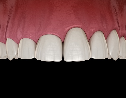 Animated gum recontouring process