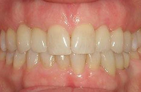 Healthy flawless smile after dental crown restoration