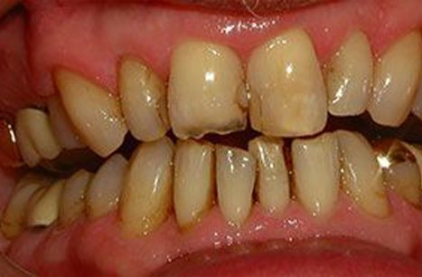 Severely decayed and worn smile before dental crown restoration