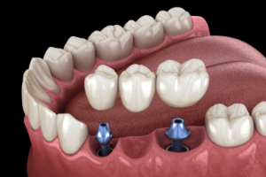 Diagram of implant bridge for multiple missing teeth in Randolph