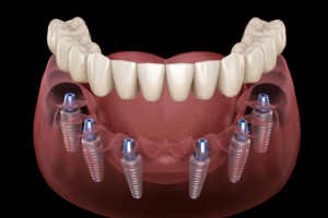 Diagram of implant dentures in Randolph