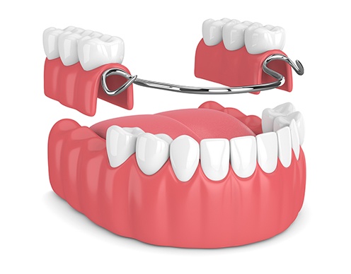 Animated partial denture placement