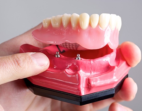 Model dental implant supported denture