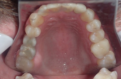 Dame Case - Bone Grafts, Tissue Grafts, Clear Braces, Implant Placement, Implant Crowns and Cosmetic Crowns and Veneers