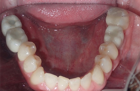 Dame Case - Bone Grafts, Tissue Grafts, Clear Braces, Implant Placement, Implant Crowns and Cosmetic Crowns and Veneers