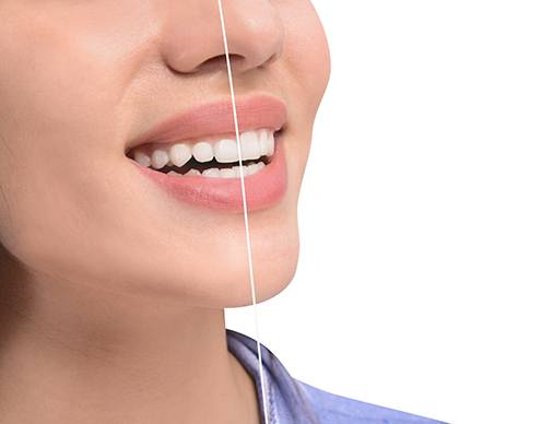Patient smile before and after gum recontouring