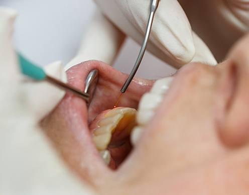 Dentist in Randolph using laser for gum recontouring procedure