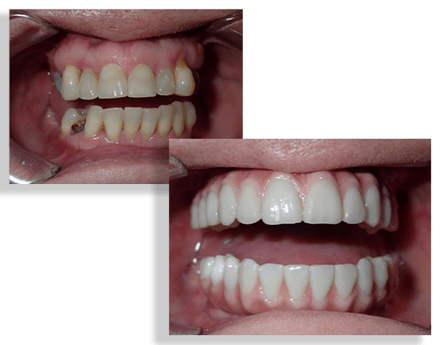 Smile before and after Prettau dental bridge restoration