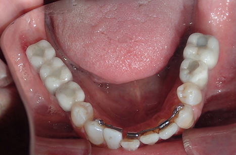 Dame Case - Bone Grafts, Tissue Grafts, Clear Braces, Implant Placement, Implant Crowns and Cosmetic Crowns and Veneers