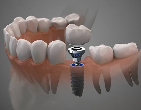 Model of how dental implants in Randolph are placed
