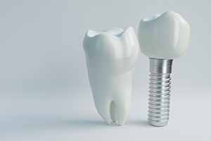 Single tooth dental implant in Randolph next to model tooth for comparison
