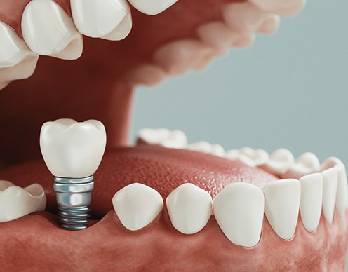 Diagram depicting how dental implants in Randolph are placed