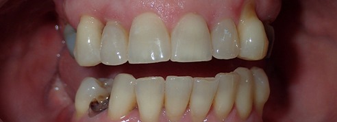 Damaged and decayed smile before cosmetic dentistry treatment