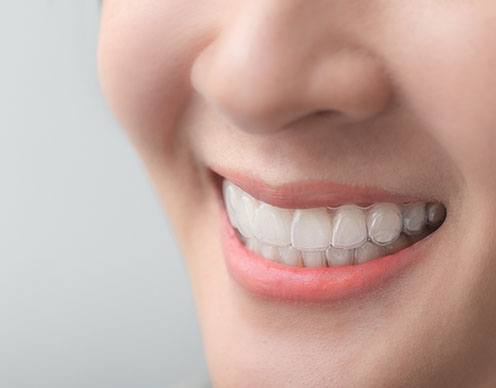Closeup of woman smiling while wearing Invisalign in Randolph