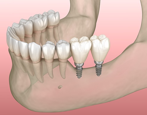 Animated smile with mini dental supported replacement tooth