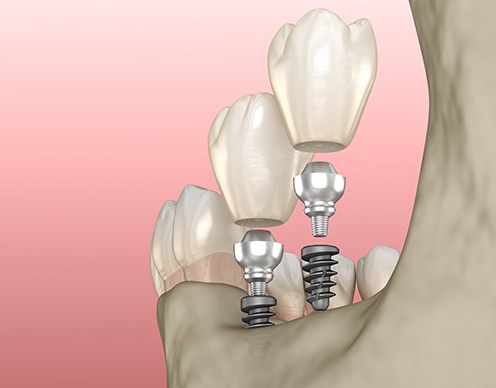Animated mini dental implant supported tooth replacement process