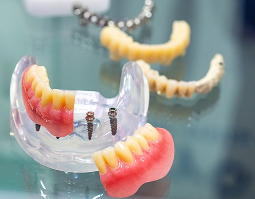 Model smile with mini dental implant supported replacement tooth