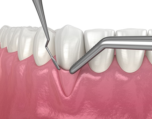 Animated gum grafting procedure