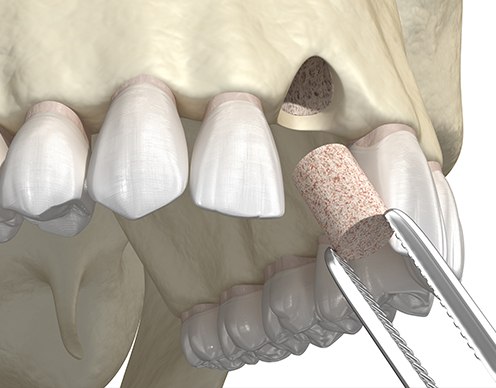 Animated bone grafting procedure