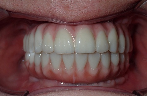 Flawelss smile after Prettau Dental Bridge restoration