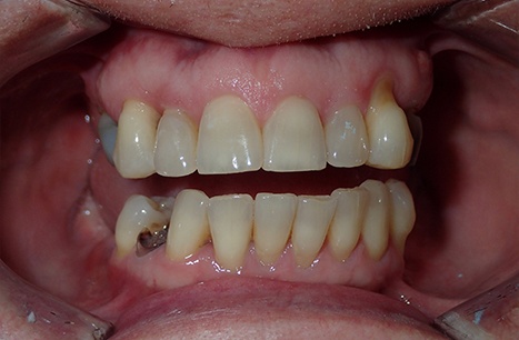Damaged and discolored teeth before Prettau Dental Bridge restoration
