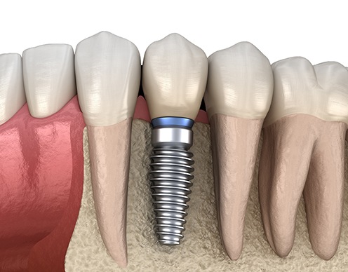 Animated smile with dental implant supported dental crown