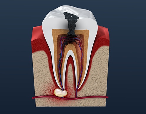 Animated damaged tooth prior to root canal treatment