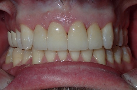 Flawelss smile after Prettau Dental Bridge restoration