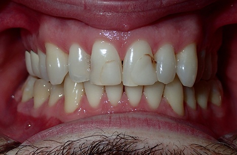 Damaged and discolored teeth before Prettau Dental Bridge restoration