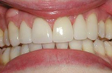 Smile restored with porcelain veneers