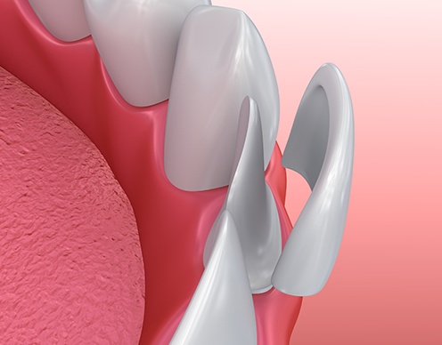 Porcelain veneer placement illustration