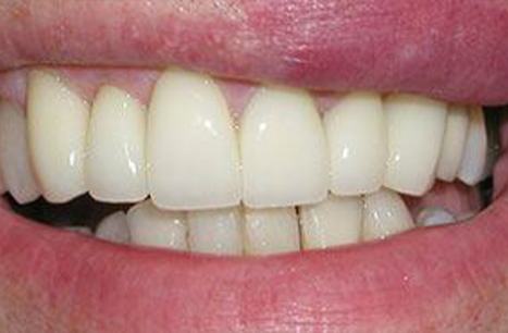 Gorgeous smile after porcelain veneers