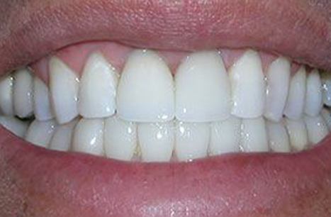 Perfected smile after porcelain veneers