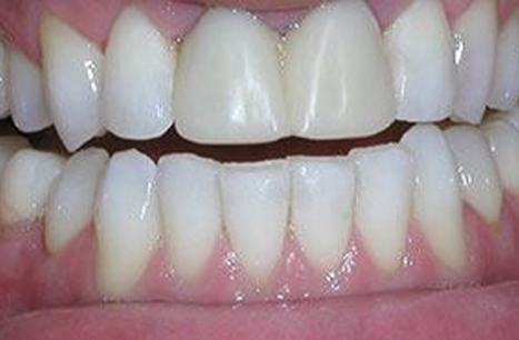 Worn teeth before porcelain veneers