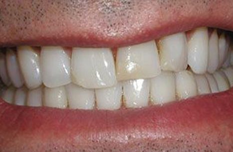 Chipped and discolored teeth before porcelain veneers