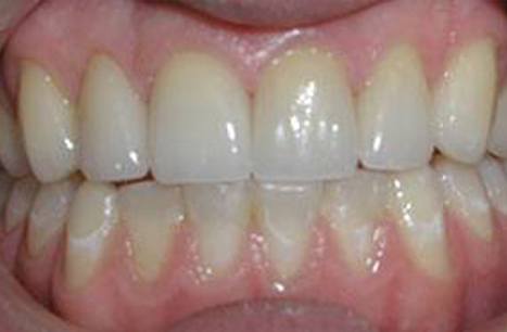 Gorgeous smile after porcelain veneers