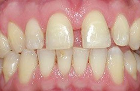 Gaps between teeth before porcelain veneers