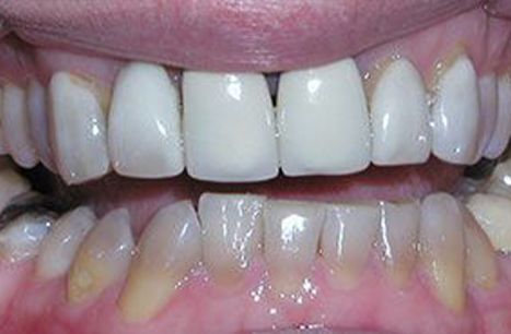 Unnatural looking dental restoration
