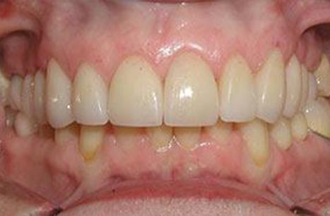 Beautiful smile after porcelain veneer placement