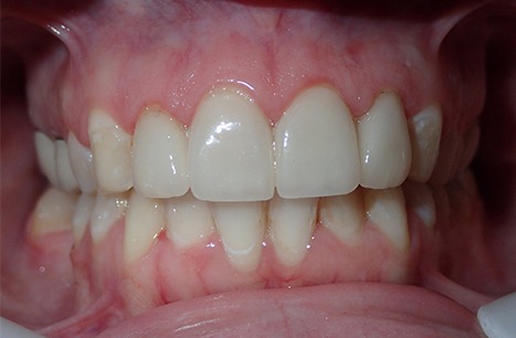 Smile restored with porcelain veneers