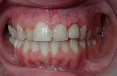 Discolored teeth and gum tissue recession
