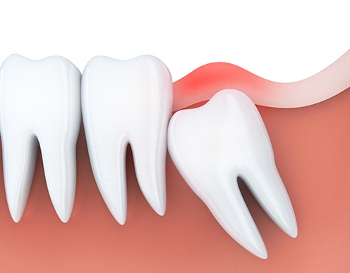 Animated smile with impacted wisdom tooth