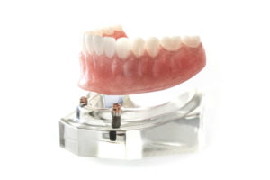 Model of an implant-retained denture