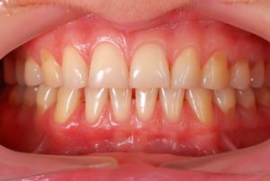 A mouth with gum disease.