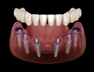 all-on-6 dental implants