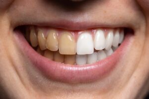 Smile showing one side of teeth stained and other side white.
