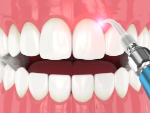 digital image of gum recontouring