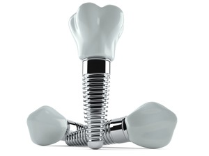 Illustration of three dental implants